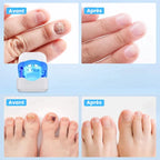 Appareil de traitement au laser pour champignon des ongles